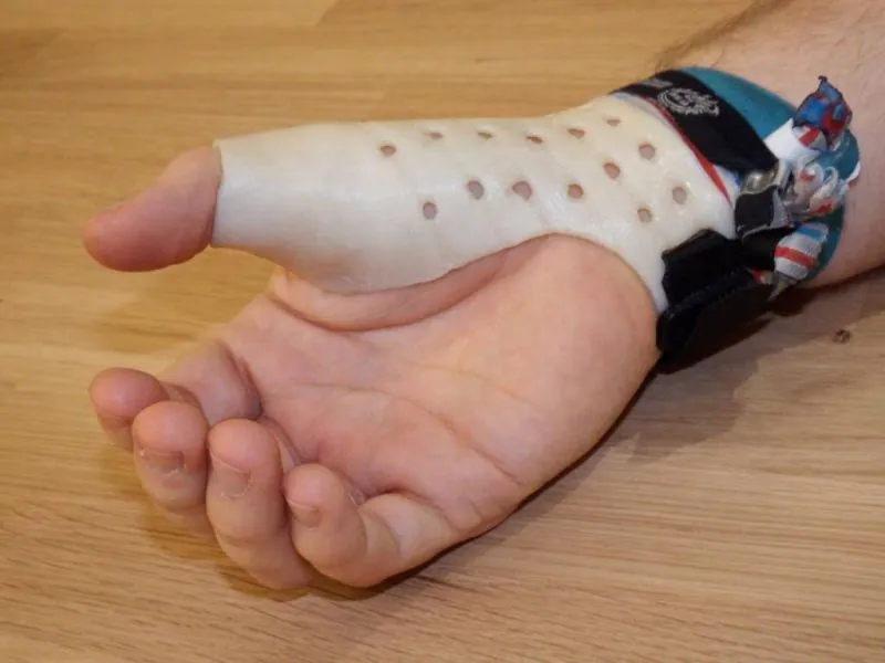 Weiße, 3D-gedruckte Daumenorthese mit Luftlöchern und Klettverschluss an einer Hand